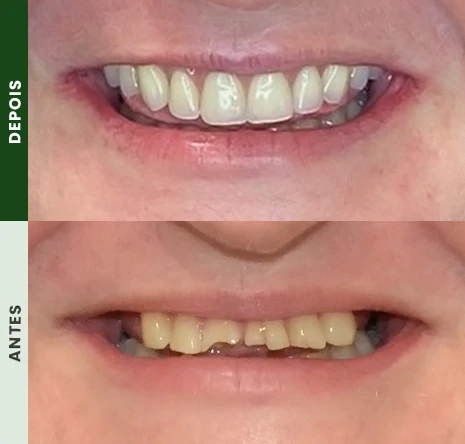 Implantes dentários em campo mourão 1cr1