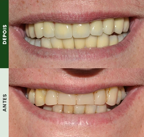 Implantes dentários em campo mourão 1cr2