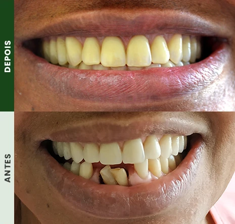 Implantes dentários em campo mourão 1cr3