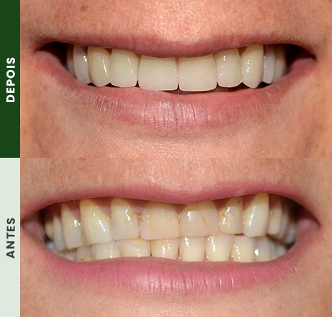 Implantes dentários em campo mourão 1cr4