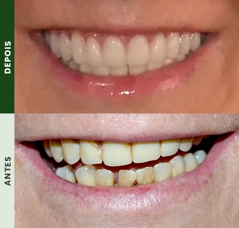 Implantes dentários em campo mourão 1cr5