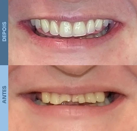 Implantes dentários em campo mourão 1cr1