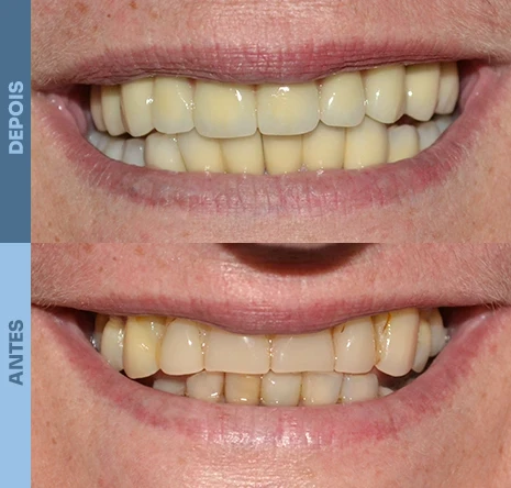 Implantes dentários em campo mourão 1cr2