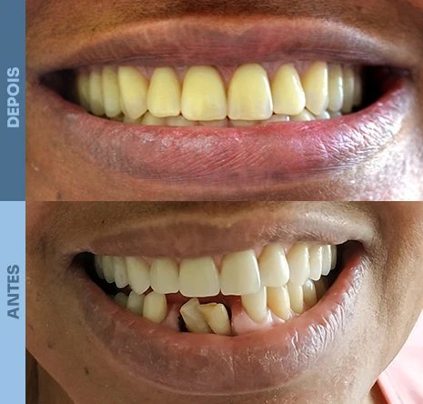 Implantes dentários em campo mourão 1cr3