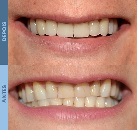 Implantes dentários em campo mourão 1cr4