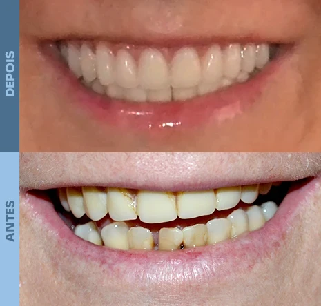 Implantes dentários em campo mourão 1cr5