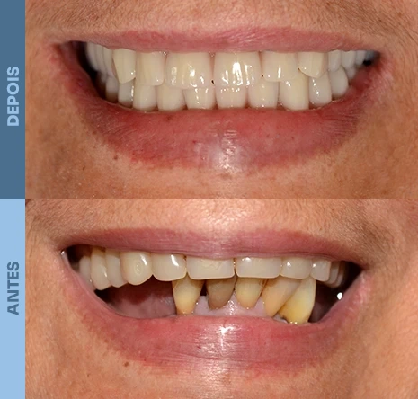 Implantes dentários em campo mourão 1cr6
